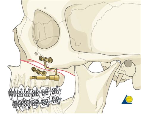 rolando prada malaspina|Lefort I Osteotomy With and Without Osteogenic Distraction in .